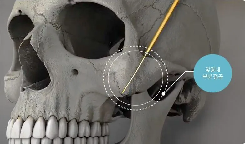 Partial osteotomy of the anterior cheekbone