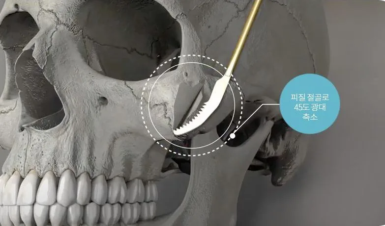 Reduction of the 45-degree cheekbone region by cortical osteotomy