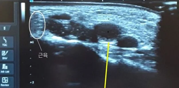 Under-eye ultrasound image showing the location of muscle and foreign material